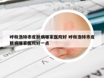 呼和浩特市皮肤病哪家医院好 呼和浩特市皮肤病哪家医院好一点