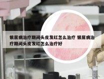 银屑病治疗期间头皮发红怎么治疗 银屑病治疗期间头皮发红怎么治疗好