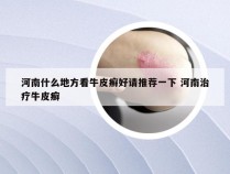 河南什么地方看牛皮癣好请推荐一下 河南治疗牛皮癣
