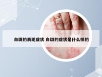 白斑的表现症状 白斑的症状是什么样的