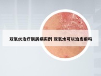 双氧水治疗银屑病实例 双氧水可以治皮癣吗