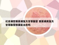 红皮病性银屑病复方甘草酸苷 银屑病用复方甘草酸苷胶囊能治愈吗