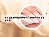银屑病皮肤如何做病理切片 银屑病病理手术怎么做