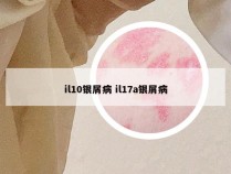il10银屑病 il17a银屑病