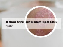 牛皮癣中医辩证 牛皮癣中医辩证是什么原因引起?