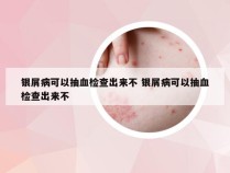 银屑病可以抽血检查出来不 银屑病可以抽血检查出来不