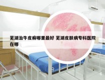 芜湖治牛皮癣哪里最好 芜湖皮肤病专科医院在哪