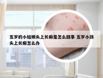 五岁的小姑娘头上长癣是怎么回事 五岁小孩头上长癣怎么办