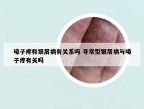 嗓子疼和银屑病有关系吗 寻常型银屑病与嗓子疼有关吗