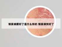银屑病要好了是什么样的 银屑病快好了