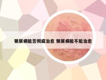 银屑病能否彻底治愈 银屑病能不能治愈