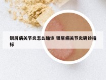 银屑病关节炎怎么确诊 银屑病关节炎确诊指标