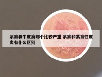 紫癜和牛皮癣哪个比较严重 紫癜和紫癜性皮炎有什么区别