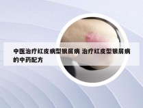 中医治疗红皮病型银屑病 治疗红皮型银屑病的中药配方