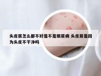 头皮屑怎么都不好是不是银屑病 头皮屑是因为头皮不干净吗
