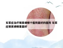 石家庄治疗银屑病哪个医院最好的医院 石家庄银屑病哪里最好