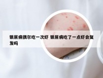 银屑病偶尔吃一次虾 银屑病吃了一点虾会复发吗