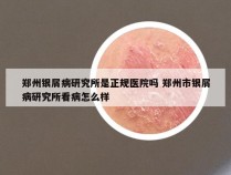 郑州银屑病研究所是正规医院吗 郑州市银屑病研究所看病怎么样