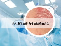 女人患牛皮癣 有牛皮肤癣的女生