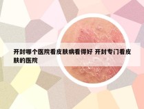 开封哪个医院看皮肤病看得好 开封专门看皮肤的医院