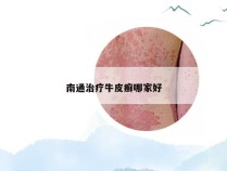 南通治疗牛皮癣哪家好