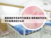 银屑病关节炎关节不能着凉 银屑病关节炎关节不能着凉吃什么药