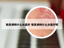 银屑病喝什么水最好 银屑病喝什么水最好呢