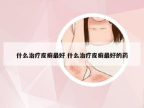 什么治疗皮癣最好 什么治疗皮癣最好的药