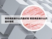 银屑病皮癣什么药最好用 银屑病皮癣什么药最好用呢