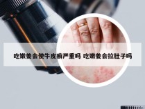 吃嫩姜会使牛皮癣严重吗 吃嫩姜会拉肚子吗