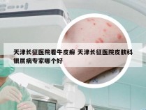 天津长征医院看牛皮癣 天津长征医院皮肤科银屑病专家哪个好