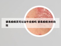 狼毒癣痒灵可以治牛皮癣吗 狼毒癣痒净的功效