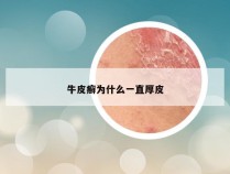 牛皮癣为什么一直厚皮