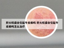 肝火旺盛会引起牛皮癣吗 肝火旺盛会引起牛皮癣吗怎么治疗