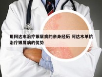 用阿达木治疗银屑病的亲身经历 阿达木单抗治疗银屑病的优势