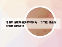 泡温泉治银屑病多长时间为一个疗程 温泉治疗银屑病的过程