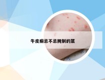 牛皮癣忌不忌腌制的菜