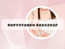 麦收季节对牛皮癣影响 麦收皮炎怎样治疗