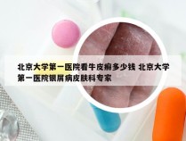 北京大学第一医院看牛皮癣多少钱 北京大学第一医院银屑病皮肤科专家