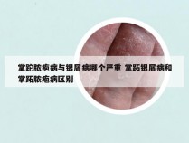 掌跎脓疱病与银屑病哪个严重 掌跖银屑病和掌跖脓疱病区别