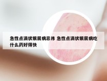 急性点滴状银屑病忌讳 急性点滴状银屑病吃什么药好得快