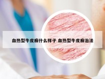 血热型牛皮癣什么样子 血热型牛皮癣治法