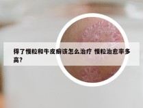 得了慢粒和牛皮癣该怎么治疗 慢粒治愈率多高?