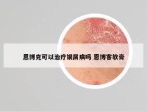 恩博克可以治疗银屑病吗 恩博客软膏