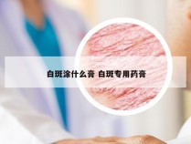 白斑涂什么膏 白斑专用药膏