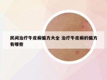 民间治疗牛皮癣偏方大全 治疗牛皮癣的偏方有哪些