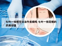 七叶一枝根可以治牛皮癣吗 七叶一枝花根的药用价值