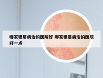 哪家银屑病治的医院好 哪家银屑病治的医院好一点