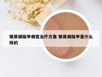 银屑病指甲病变治疗方案 银屑病指甲是什么样的