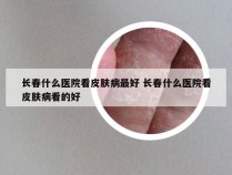 长春什么医院看皮肤病最好 长春什么医院看皮肤病看的好